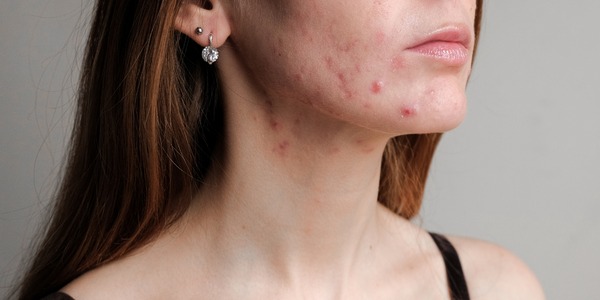 acne na mulher adulta